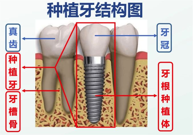 钛基牙根种植体基于电场刺激的【项目简介】该团队克服现有消毒柜高能