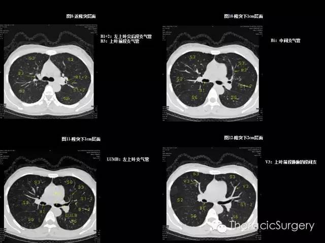 肺部ct图片怎样看懂图片