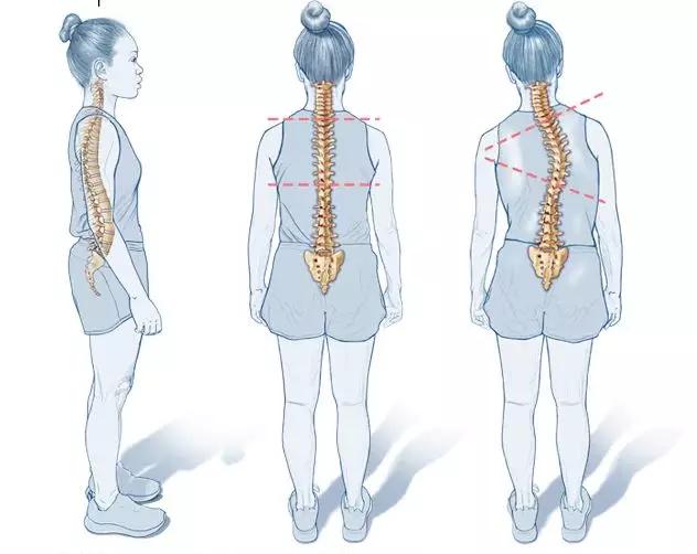 腰疼就是腰椎间盘突出不不不可能是它惹的祸