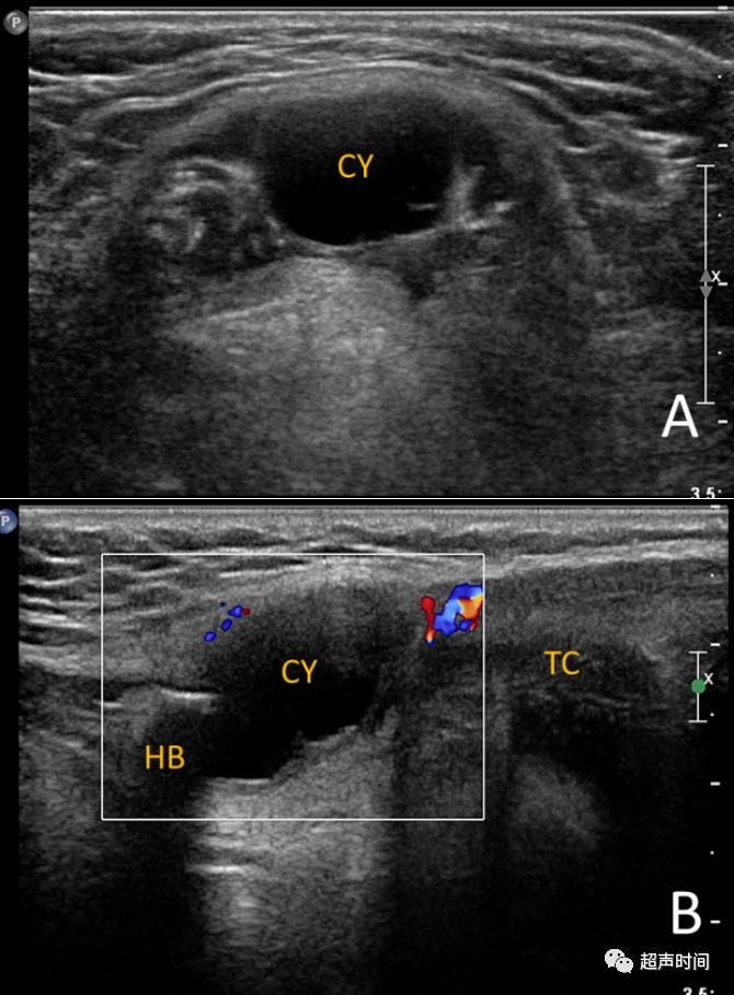 甲狀舌管囊腫淺顯易懂但超聲知識點都在