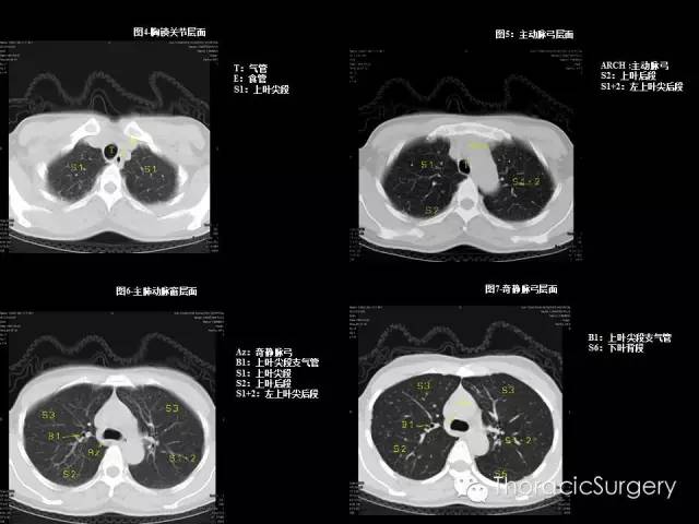 学习贴:胸部ct肺段详解