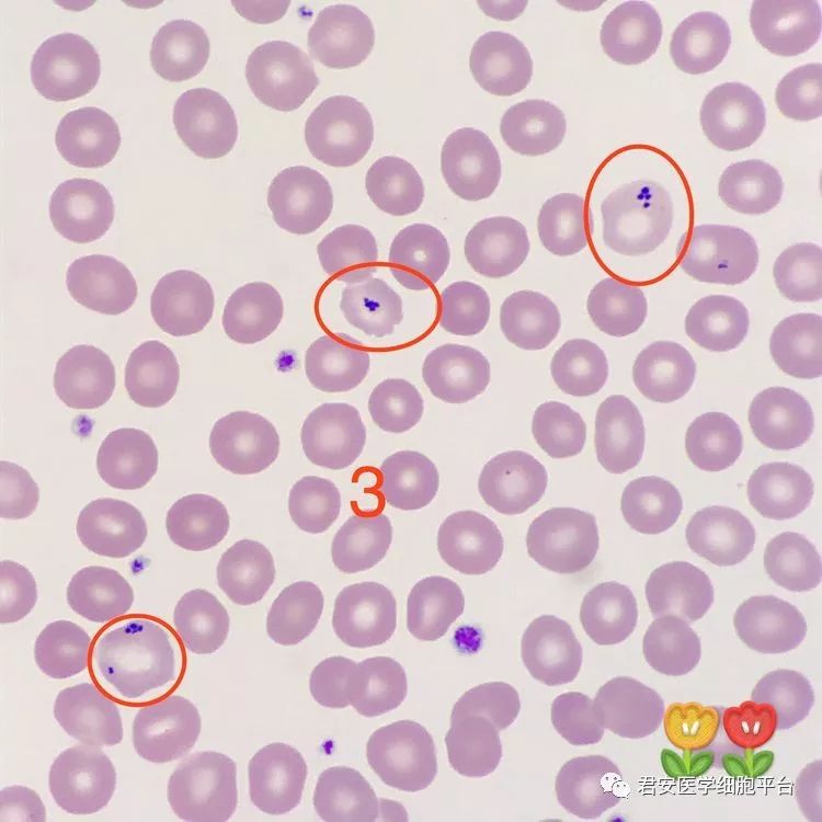 03形态特征:感染虫体的红细胞胀大,不规则;虫体红核蓝浆,胞核常偏于