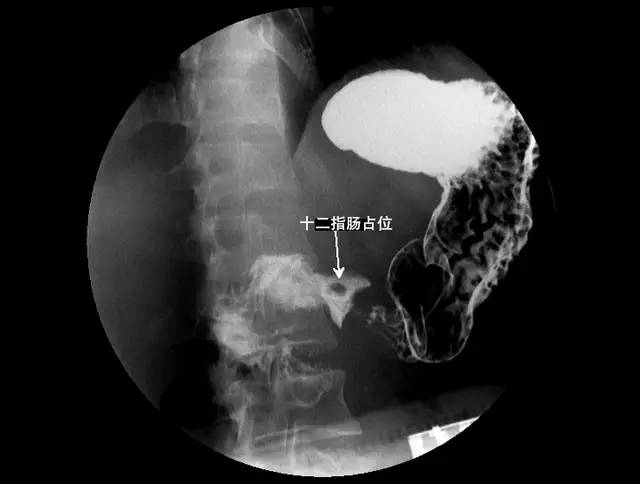 十二指腸低張造影能顯示腫物影像,並可顯示內鏡不易見到的橫部或因腸