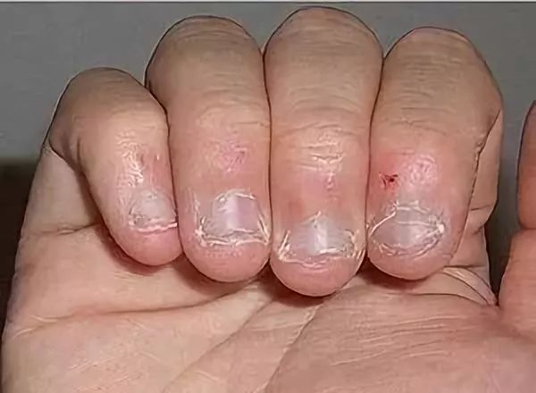 爱咬指甲的孩子到底是哪里出了问题