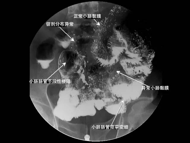 胃腸鋇餐造影以空腸段改變最為明顯.