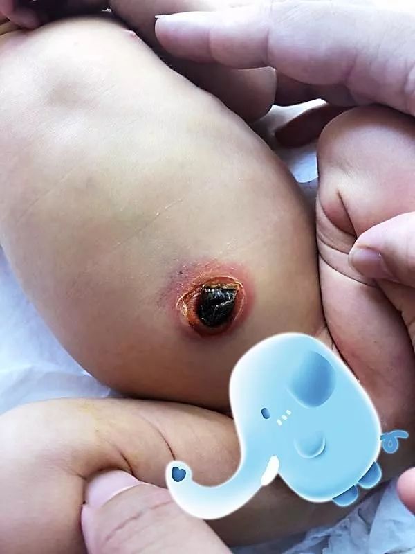 儿研所儿医说脐带消毒也是个技术活