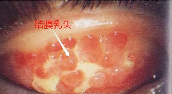 眼睛结膜滤泡图片图片