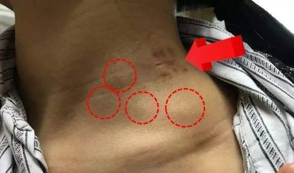 但是,如果乳腺癌转移到锁骨上淋巴结,那就属于远处转移了,属于四期的