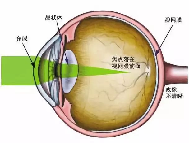 【科普】眼球啊,你为什么会近视呢?