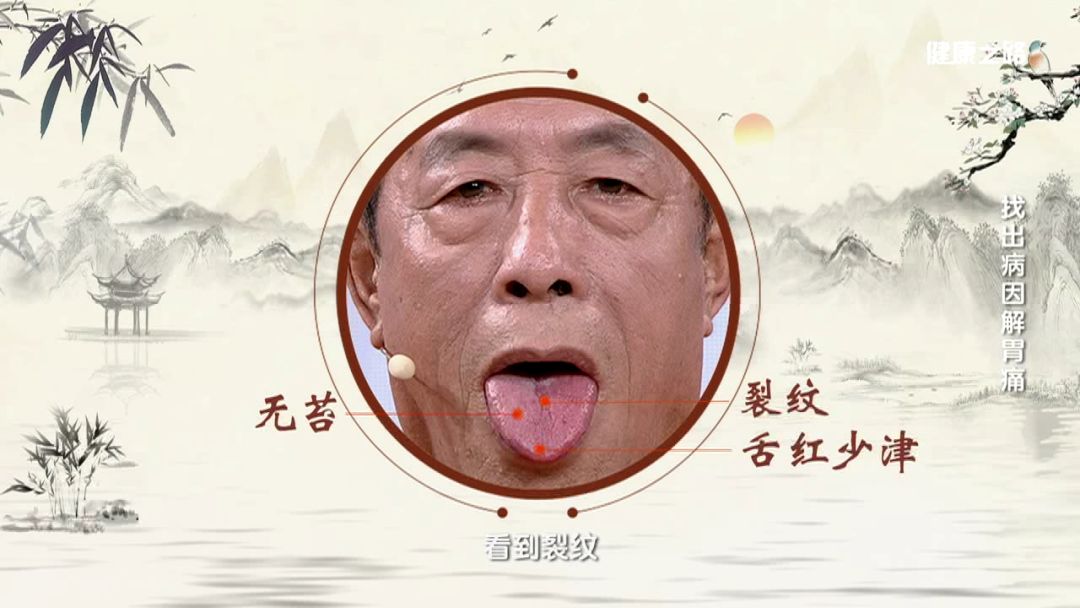 慢性浅表性胃炎,萎缩性胃炎,胃溃疡背后都见它!你的胃还好吗?