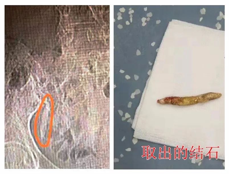 【微创技术】小小输尿管中取出5厘米大的结石!