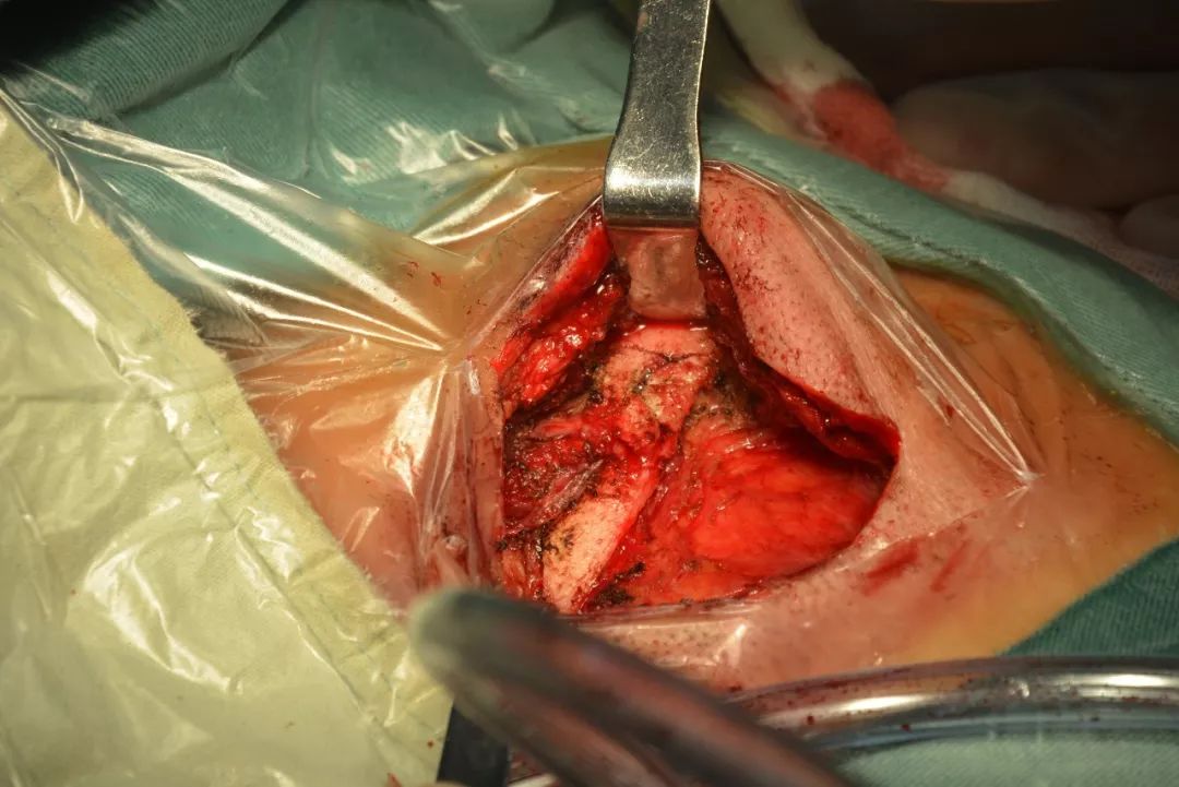 【重点记录】一天三台手术,新晨神外再上台阶