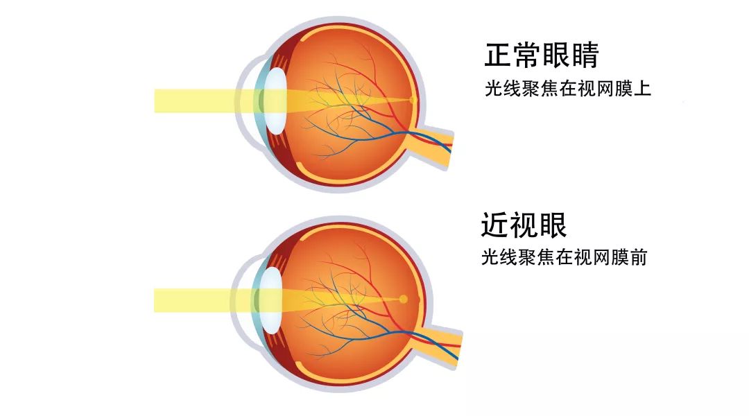而近视,是指远处的平行光线进入眼睛,最终会聚焦到视网膜前面,主要是