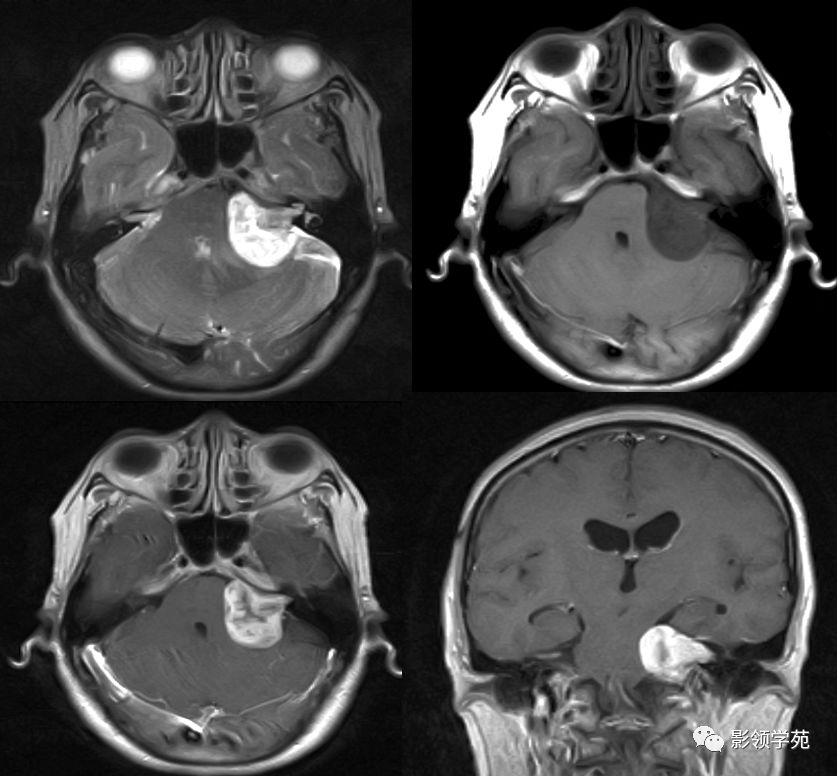 后颅窝肿瘤诊断与鉴别诊断