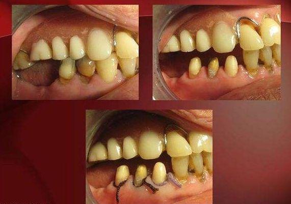 牙齿松动要拔掉吗牙齿松动拔牙好不好