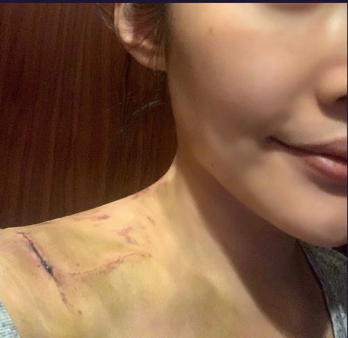 徐冬冬手术事故后再晒照伤口已有明显好转黑紫色刀疤仍清晰