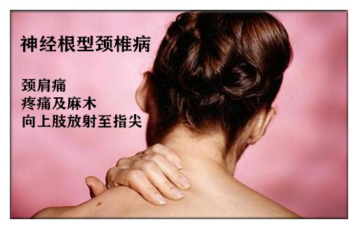 "臂丛神经牵拉实验"竟然可以治疗颈椎僵硬,转头不利,头痛头晕.