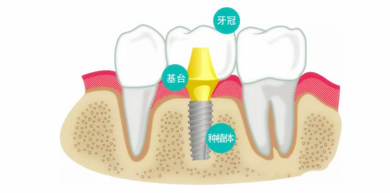 深圳瑞典诺贝尔种植体:我选这个种植牙系统的初衷_品牌