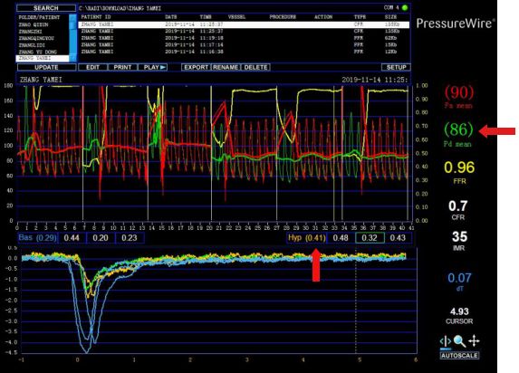 辽宁省人民医院心血管病治疗中心成功开展心肌微循环阻力指数imr检测