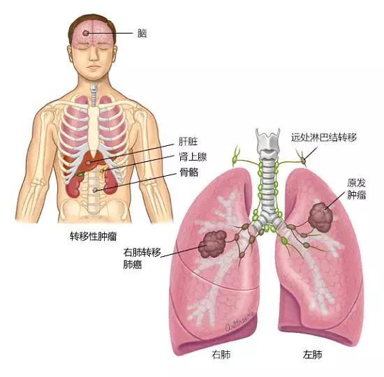 肺癌转移会有什么症状表现