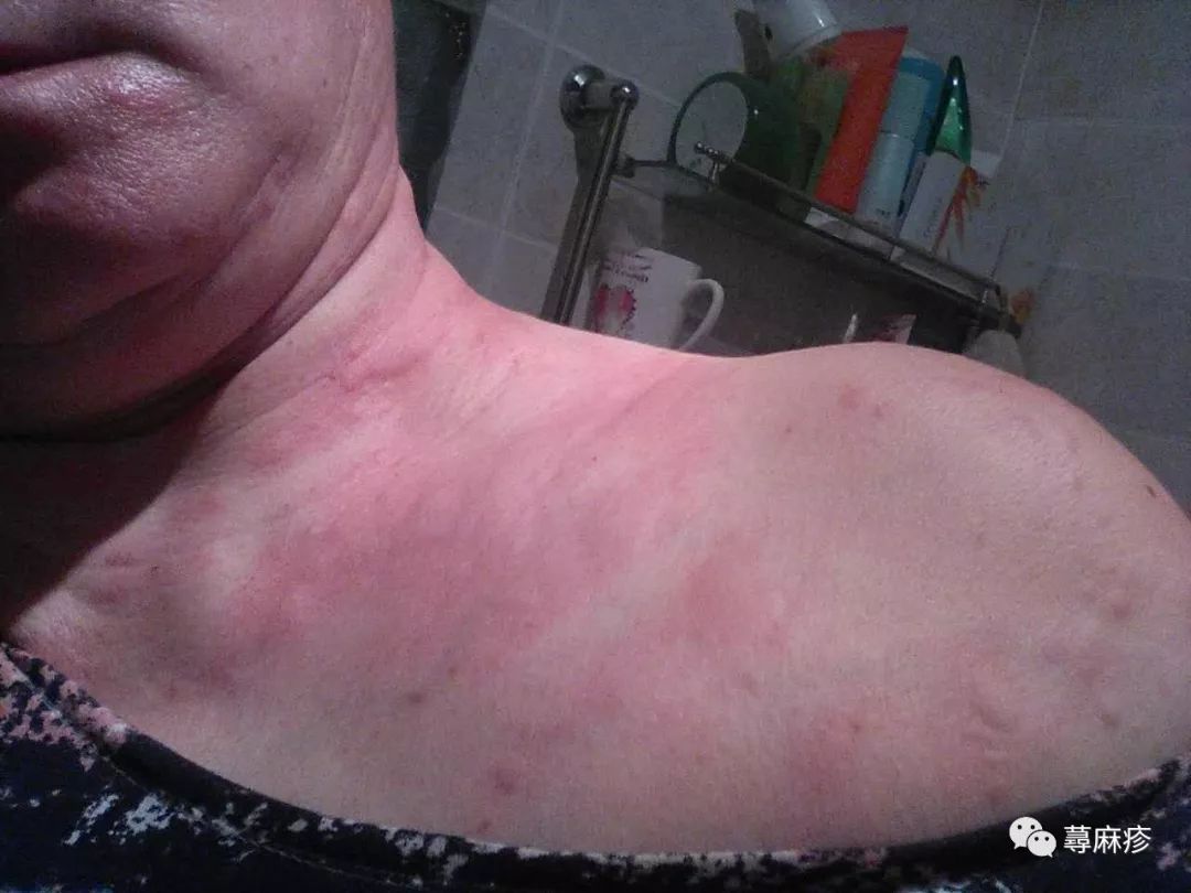 荨麻疹图片荨麻疹类型如何自我诊断