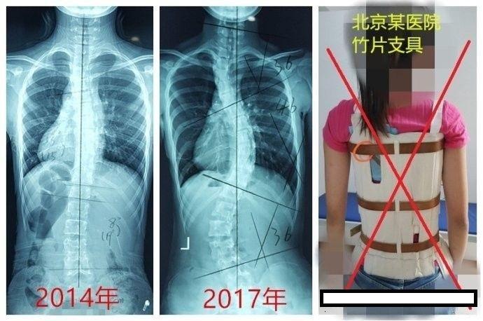 脊柱側彎在治療中加重了怎麼辦?