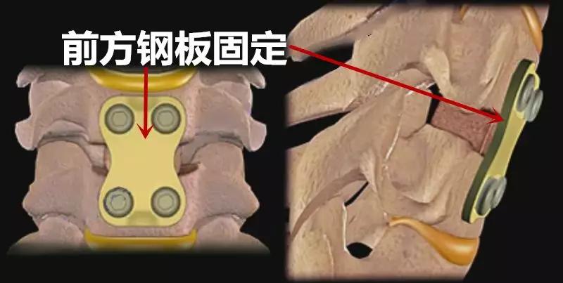 不知道这 3 类颈椎病手术,你还敢做手术?