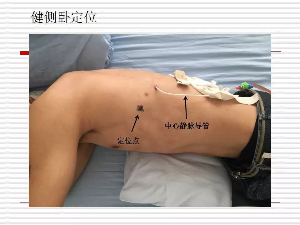 内科胸腔镜技术及应用体会_胸膜