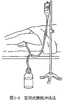 二,膀胱冲洗的种类包括密闭式冲洗法(图3