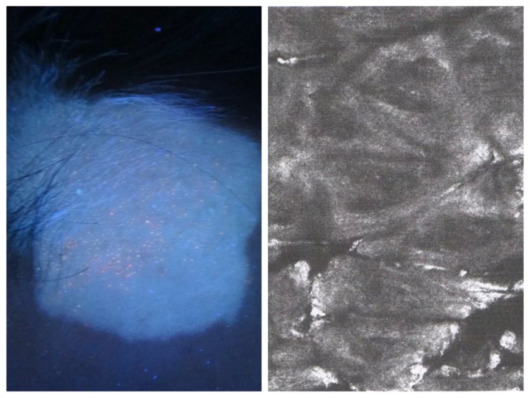 (治疗前皮肤ct检测下黑色素严重缺失)(治疗中皮肤ct检测下显色情况)