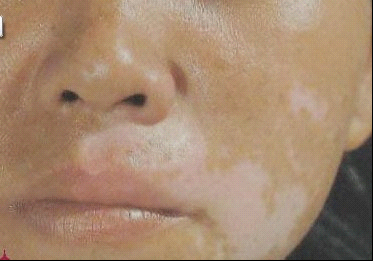 而如果仅止步于此,那汞不至于导致全身毒性反应,至多像氢醌使用不当