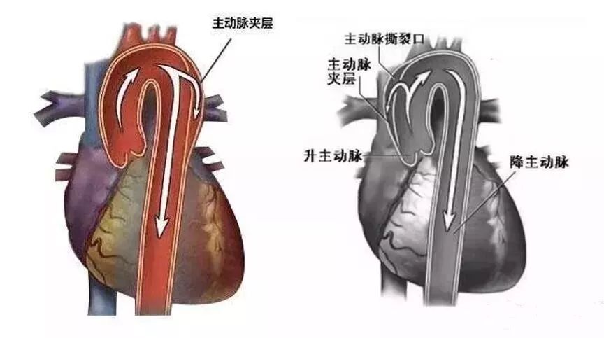 不明原因的胸背部疼痛,需警惕!