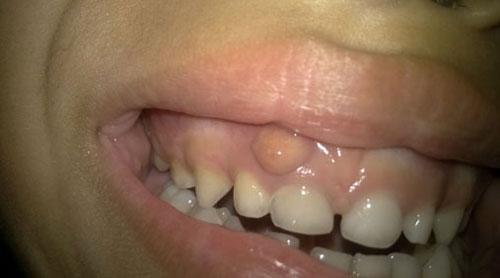 牙龈脓包怎么回事?