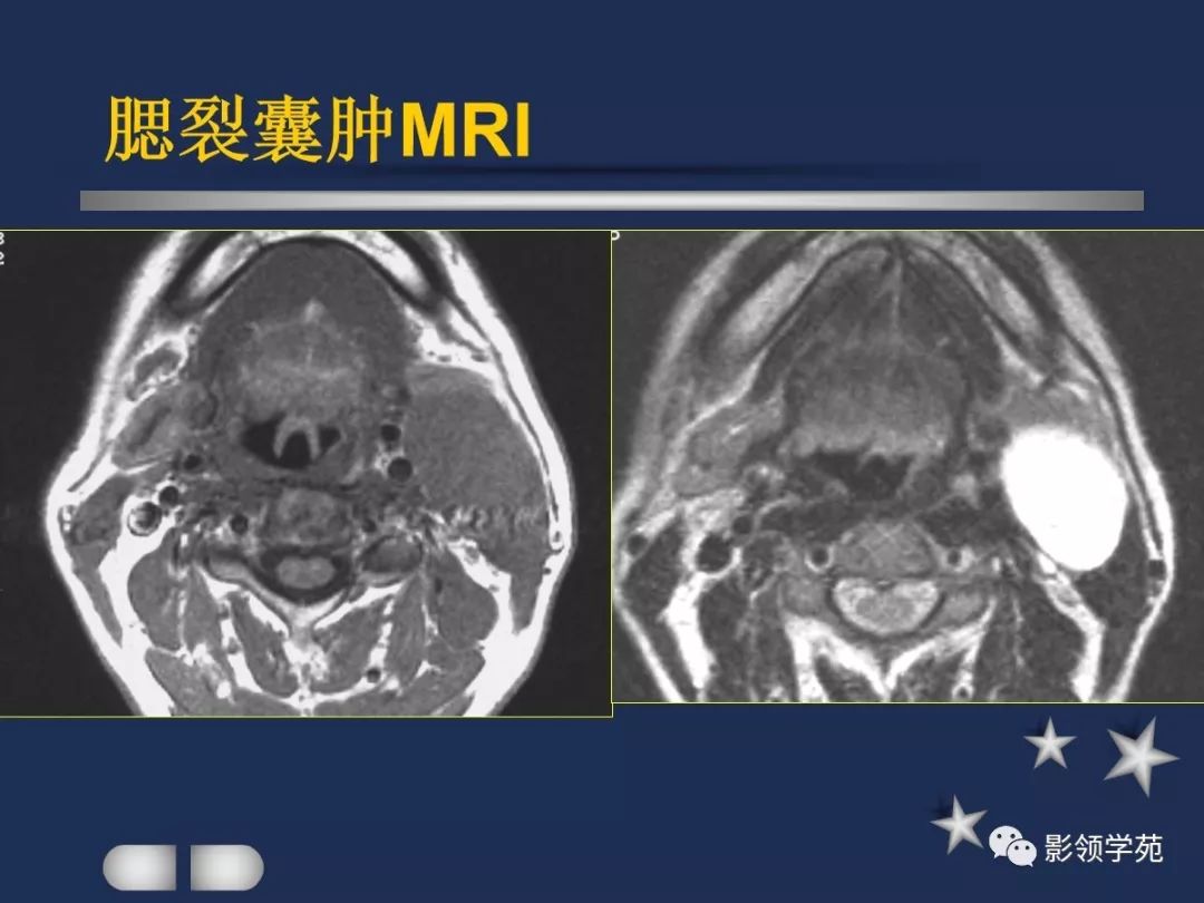 下至下頜角,是莖突前咽旁間隙重要器官腮腺解剖淋巴結腫大性疾病頸