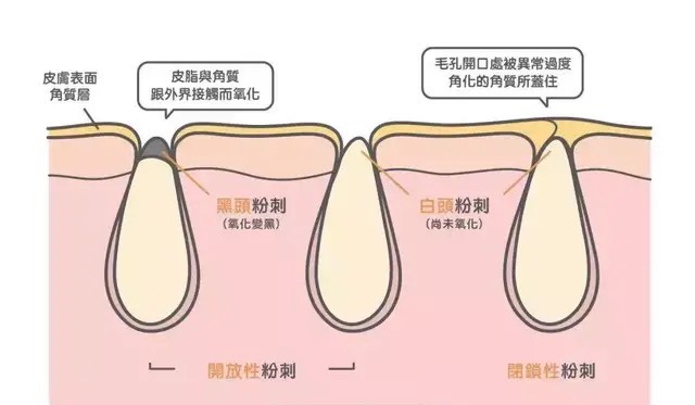 日积月累而形成脂肪栓 它也叫白头粉刺,是因为油脂硬化后而形成的