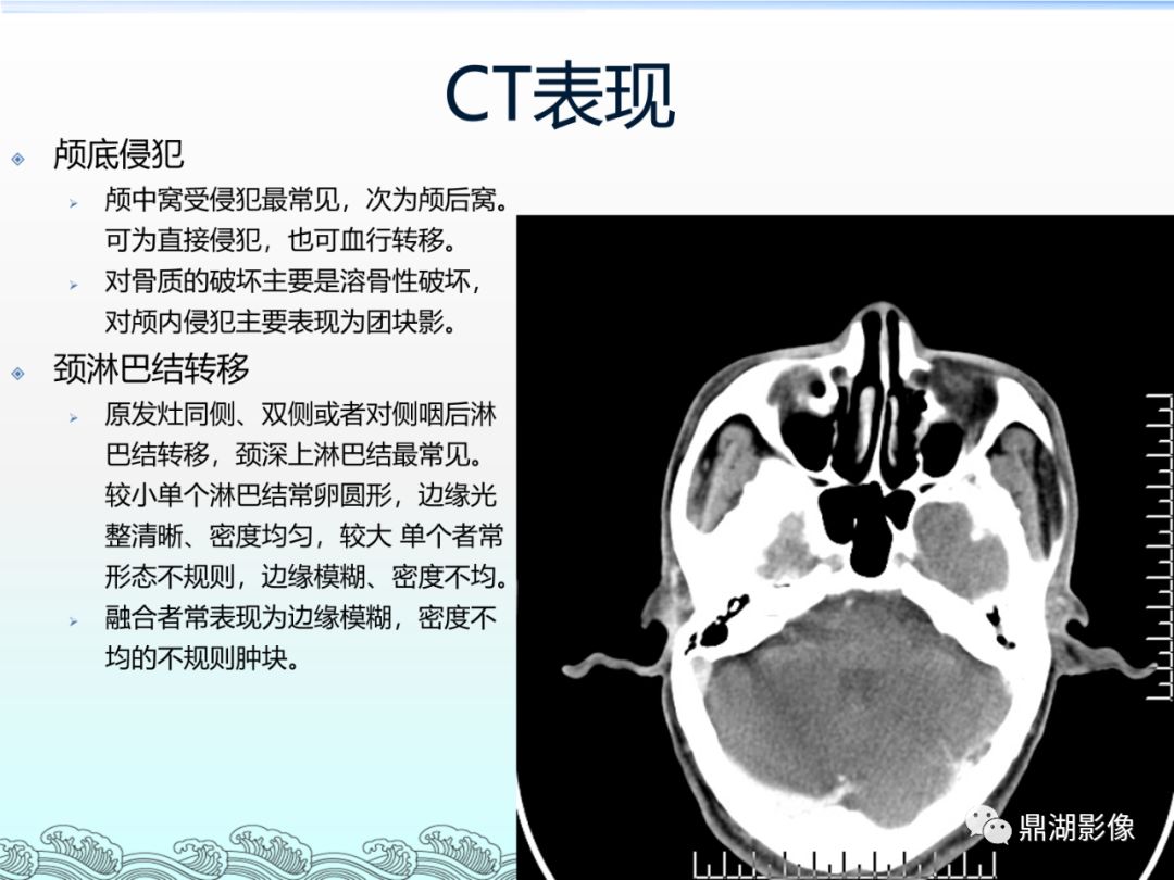 鼻咽癌的ct診斷與鑑別診斷