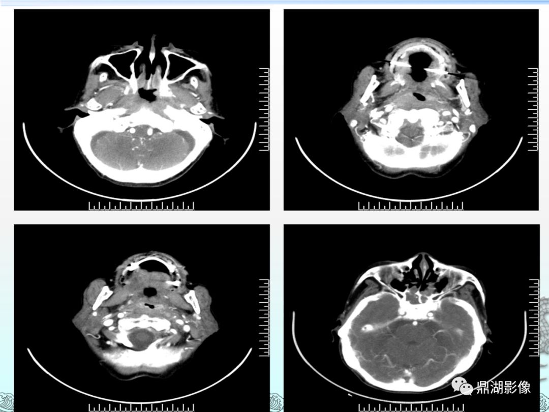 鼻咽癌的ct诊断与鉴别诊断