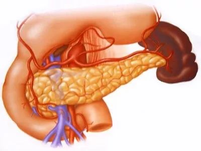 这种胰腺囊肿做个"胃镜"就能治