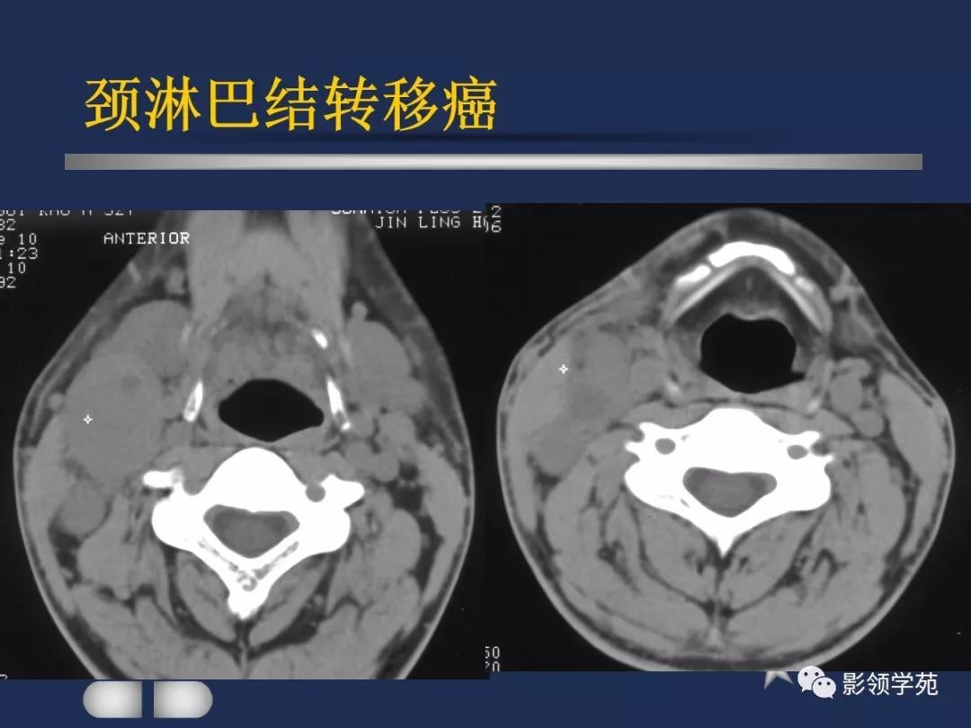 下至下頜角,是莖突前咽旁間隙重要器官腮腺解剖淋巴結腫大性疾病頸