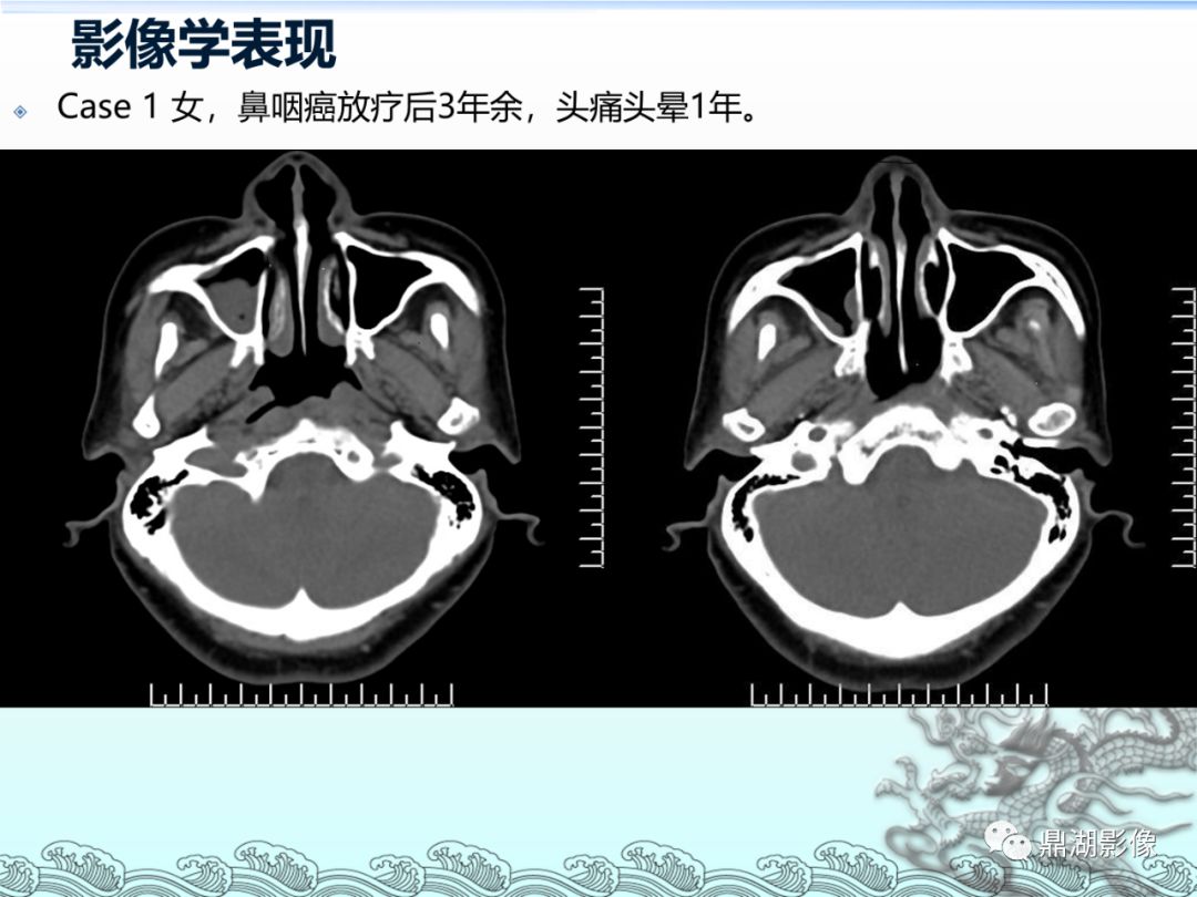 鼻咽癌的ct诊断与鉴别诊断