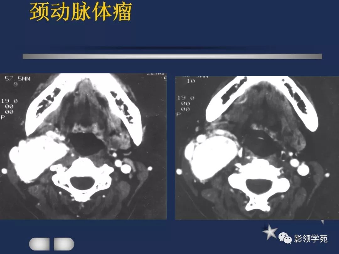 下至下頜角,是莖突前咽旁間隙重要器官腮腺解剖淋巴結腫大性疾病頸