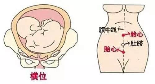 横位的胎心位置示意图图片