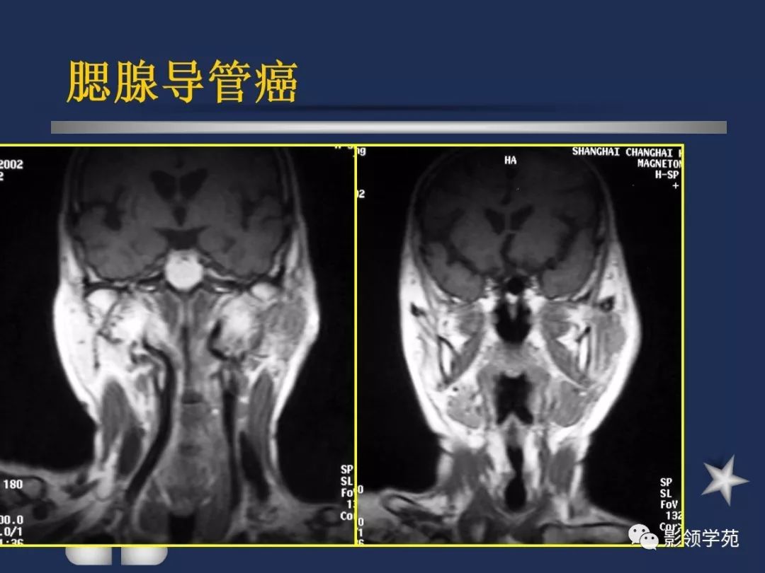 腮腺頸部疾病影像診斷