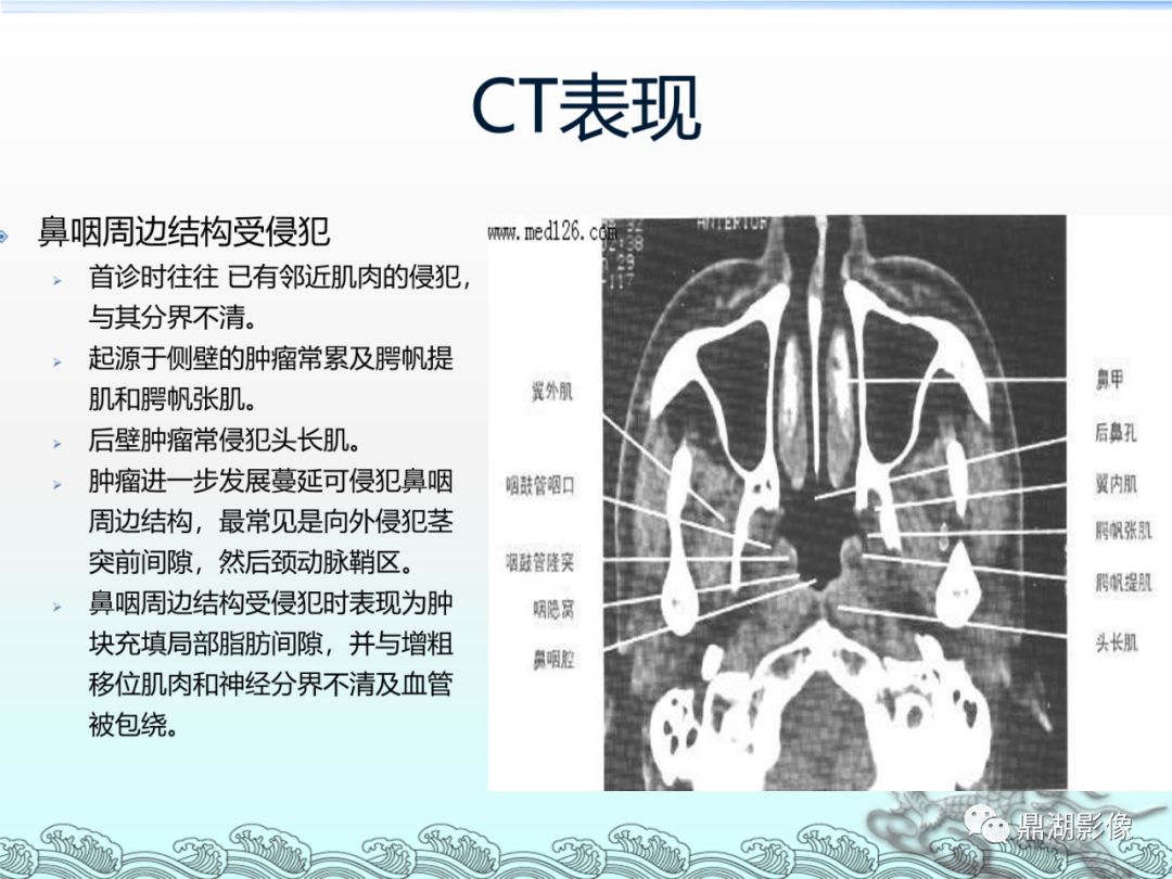鼻咽部ct扫描范围图片图片