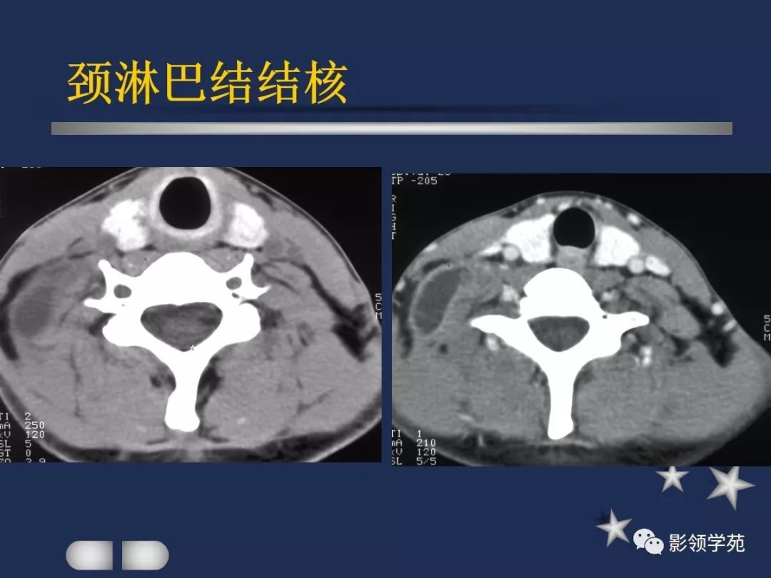 下至下頜角,是莖突前咽旁間隙重要器官腮腺解剖淋巴結腫大性疾病頸