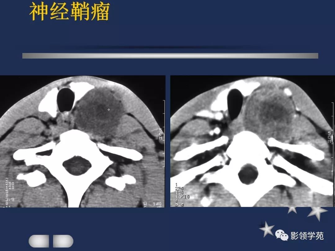 下至下頜角,是莖突前咽旁間隙重要器官腮腺解剖淋巴結腫大性疾病頸