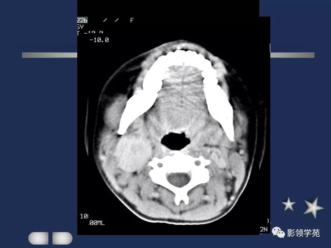 腮腺內血管顯示清楚腮腺是脂肪性腺體,ct呈低密度位於下頜骨後,胸鎖