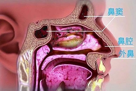 首大计成:感冒,鼻塞,流鼻涕超过10天要考虑是否是鼻窦炎