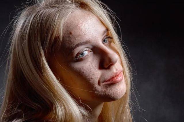 2,螨虫的排泄物会作为灰尘卷进空气,并通过呼吸进入人体的呼吸道.