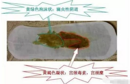 身体有什么问题雪莲贴就会排出什么毒素不会看贴的家人赶快了自我对照